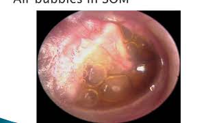 Otitis Media with Effusion  ENT Lecture Series [upl. by Kielty]