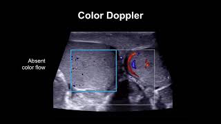 Clinical training 3  MOTOR EXAMINATION Superficial Reflexes [upl. by Artemisa]