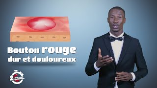 2mn pour comprendre LE FURONCLE du 27 Janvier 2020 [upl. by Lananna]