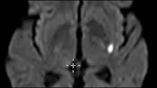 Acute lacunar infarction basal ganglia [upl. by Ardelle802]