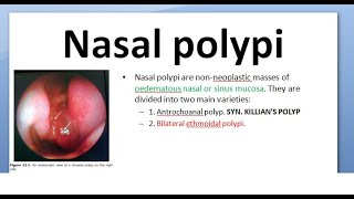 ENT Antrochoanal polyp Killian Ethmoidal bilateral difference compare Nasal polypi [upl. by Ttezil]