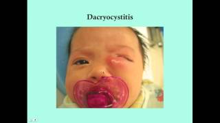 Dacryocystitis  CRASH Medical Review Series [upl. by Eat817]