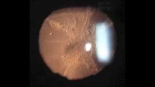 Pupillary Light Reflex – Pathway amp Lesions  Neuro ophthalmology [upl. by Nolyk]