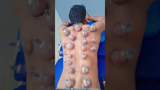 How copping hijama therapy back [upl. by Nylhtac]