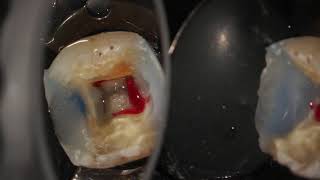 Complete endodontic treatment of a lower first molar step by step [upl. by Brunella]