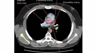 Anatomy of a Transverse CT of the Thorax [upl. by Mosnar373]