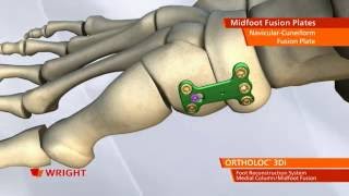 Ortholoc Midfoot Fusion Animation [upl. by Gervais]