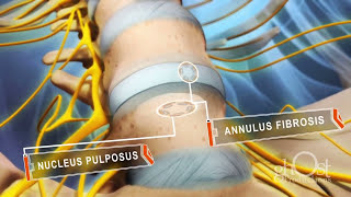 Herniated DISC Medical Animation  Ghost Medical Animation amp Surgical VR [upl. by Malachi936]