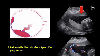 Ultrasound Imaging of the placenta Part 1 Anatomy and Variants [upl. by Silletram]