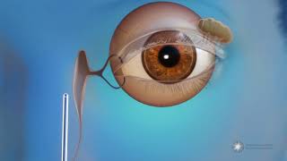 What is endoscopic dacryocystorhinostomy DCR surgery for blocked tear ducts [upl. by Htilil]