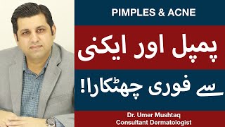 How To Remove Pimples Overnight  Acne Treatment  Pimple Khatam Karne Ka Tarika [upl. by Einreb374]