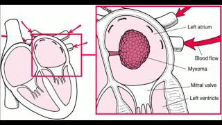 Left atrial myxoma [upl. by Arytahs85]