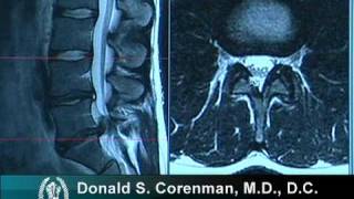 How to Read a MRI of a Lumbar Herniated Disc  Lower Back Pain  Colorado Spine Surgeon [upl. by Laurin]