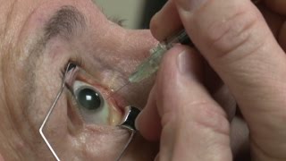 Eyeball injections equal eyepopping profits [upl. by Weisbrodt]