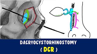 Dacryocystorhinostomy  DCR surgery [upl. by Nnylaf]