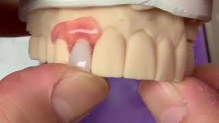 3D printed Mini Dentures [upl. by Clute]