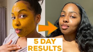 I DID A 5 DAY TURMERIC FACE MASK amp This Happened  MISS C Beauty [upl. by Urbana234]