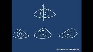 Ptosis Tutorial  A Practical Approach [upl. by Justina]