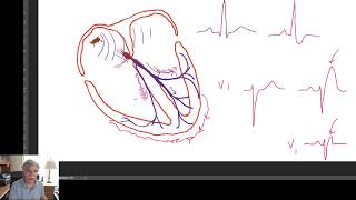 Amyotrophic Lateral Sclerosis Fasciculation [upl. by Manwell179]