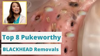 Dr Pimple Poppers 8 WORST Blackhead Removals  Youre not going to want to eat while you watch this [upl. by Grazia]