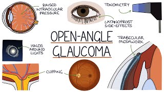 Glaucoma Treatment in Ayurveda  Glaucoma Causes Symptoms  Natural Glaucoma Cure [upl. by Doowron]