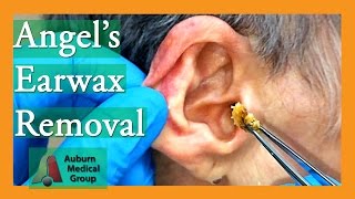 Angels Earwax Removal  Auburn Medical Group [upl. by Ahseenyt]