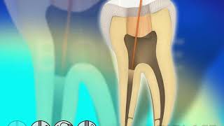 Endodontic Root Canal Disinfection  Waterlase Laser Dentistry [upl. by Bonnee]