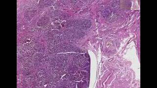 Histopathology LiverPrimary biliary cirrhosis [upl. by Zampino]