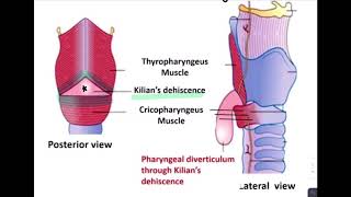 ESOPHAGEAL DIVERTICULUM [upl. by Ritch]