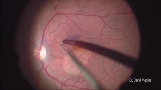 Macular Hole Surgery [upl. by Scarrow]