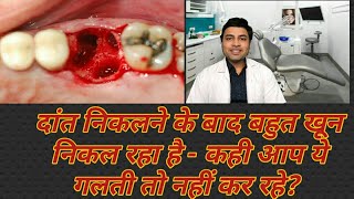 Bleeding after tooth extraction how to stop  Bleeding after tooth removal  Dr Pranay Thakkar [upl. by Timoteo980]