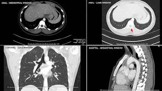 Introduction to Computed Tomographic imaging of the Chest [upl. by Ebneter456]