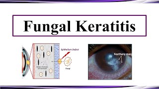 Fungal Keratitis [upl. by Ailaht]