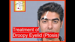 Droopy Eyelid ptosis Treatment and Surgery [upl. by Trauner709]