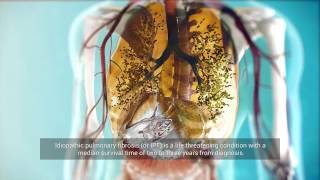 Life with Pulmonary Fibrosis  Supplemental Oxygen [upl. by Thetes]