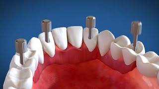 Video Animazione 3D Implantologia dentale a carico immediato Sistema Modulabile [upl. by Laram]