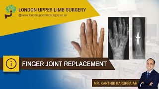 Finger joint replacement [upl. by Shane]