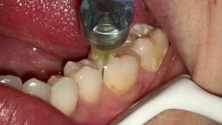 Endodontia de Molar Inferior [upl. by Asial745]