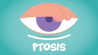 What is Ptosis [upl. by Merriam256]