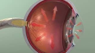 Glaucoma ophthalmology [upl. by Shaughnessy]