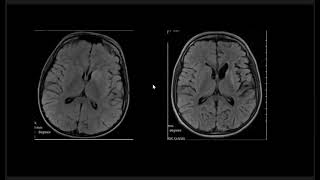 Basal Ganglia Lesions  Part 1 [upl. by Ssirk134]