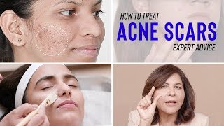 TCA Cross for Acne Scars DARK SKIN TONE Full Procedure Los Angeles CA [upl. by Alys]