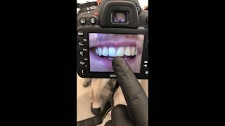 Correcting Crooked Teeth With Composite Bonding BeforeAfter [upl. by Eekram]