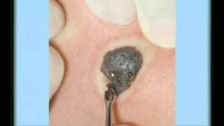 Seborrheic Keratosis Treatment [upl. by Raasch151]