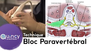 Tutoriel AIH  Le myélogramme sternal [upl. by Colb]