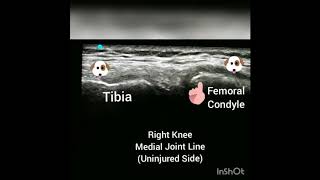 Dynamic Ultrasound of Medial Collateral Ligament MCL Sprain Strain [upl. by Amoeji506]