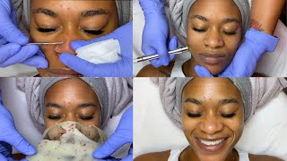 Double Exfoliation Facial w Microdermabrasion  GlamByLiaLeigh [upl. by Nonnaihr416]