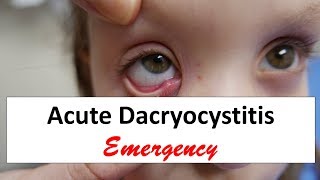 Acute Dacryocystitis Emergency [upl. by Eseilana]