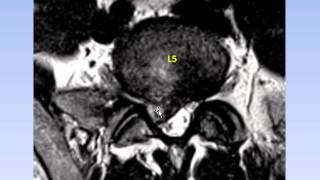 Dr Gillard Lectures on Lumbar Disc Herniation  Protrusion Part II of II [upl. by Esemaj497]