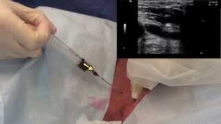 Pleural Boutin Trocar Biopsy [upl. by Vtarj410]